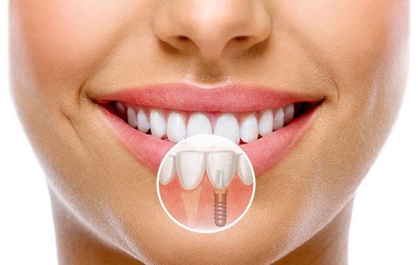 Diş İmplantı Sonrası Konuşma Değişir mi?
