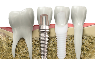 Dental İmplant Cerrahisi: Kayıp Dişlerin Kalıcı ve Güvenilir Çözümü