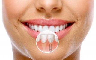 Diş İmplantı Sonrası Konuşma Değişir mi?