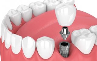 Diş İmplantları Biyoteknolojinin Neresinde?