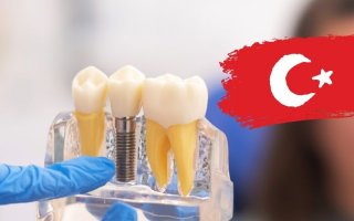 Türkiye’de İmplant Yaptırmak: Yabancılar Neden Burayı Tercih Ediyor?